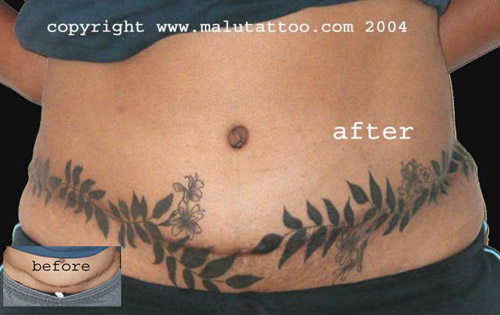 Tattoo Tummy Tuck Coverup 